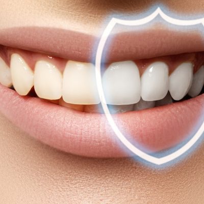 Perfect smile before and after bleaching. Dental care and whitening teeth. Stomatology and beauty care. Woman smiling with great teeth. Cheerful female smile with fresh clear skin